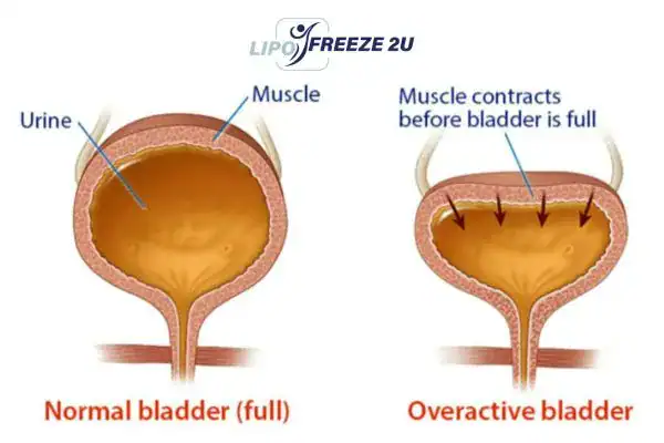 diagram of overactive bladder treatment St Neots