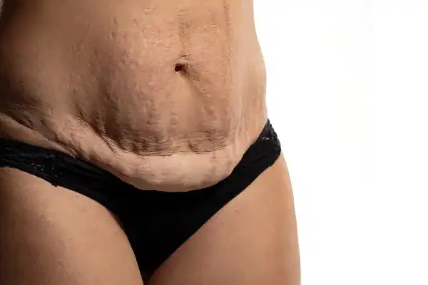 loose skin after weight loss injections St Neots