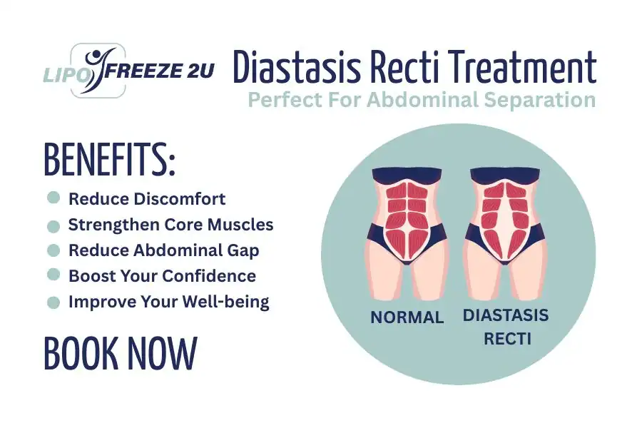 Benefits of body toning treatment St Neots for Diastasis recti