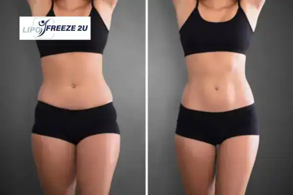 How Can LIPO FREEZE 2U Support Your Post-Pregnancy Body Recovery St Neots?