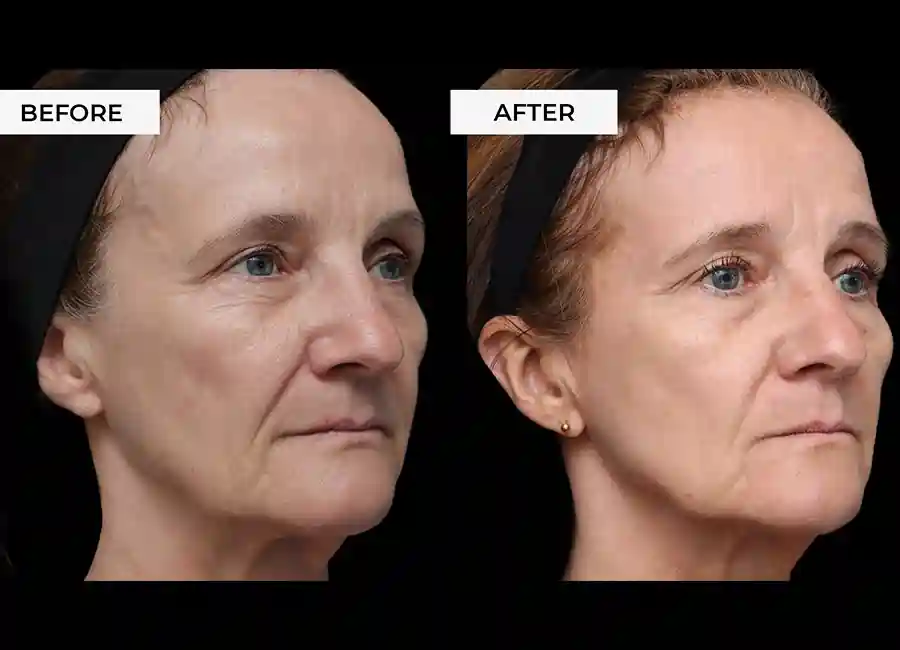 How Many RF Microneedling Sessions Will You Need to See a Difference St Neots?
