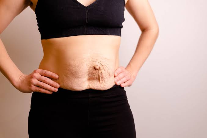 Is Surgery Really the Only Way to Repair Diastasis Recti St Neots?