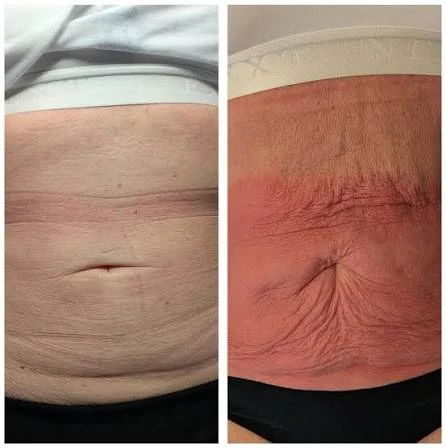 How Does RF Microneedling Improve Crepey, Thin and Uneven Skin Texture St Neots?