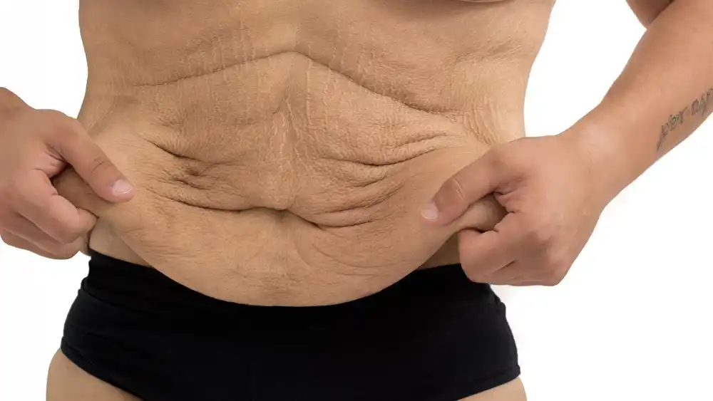 RF Microneedling for Loose Skin: How Can It Help Tighten and Reshape the Skin St Neots?